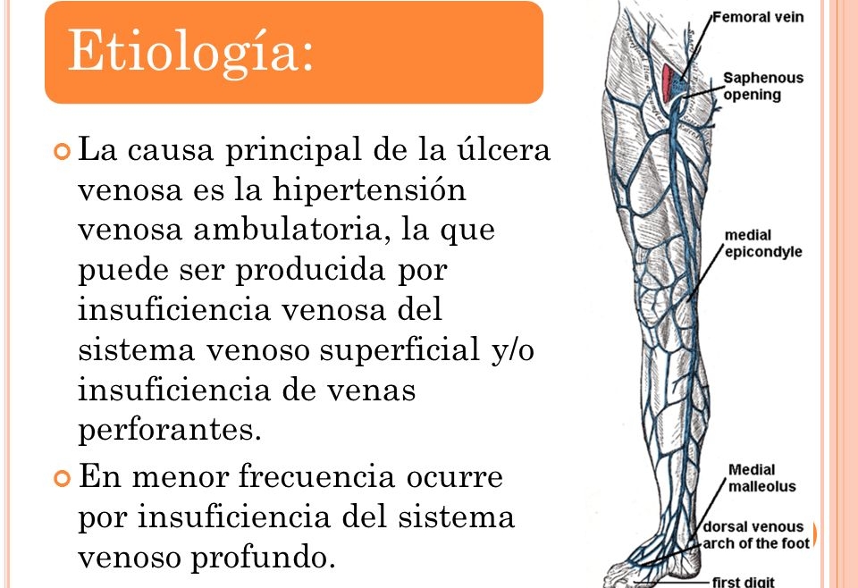 Mitos y verdades sobre las úlceras venosas