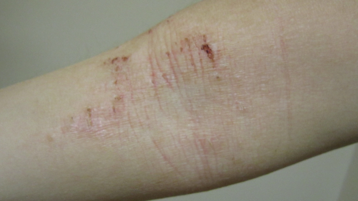 La dermatitis atópica no es sólo un brote en la piel