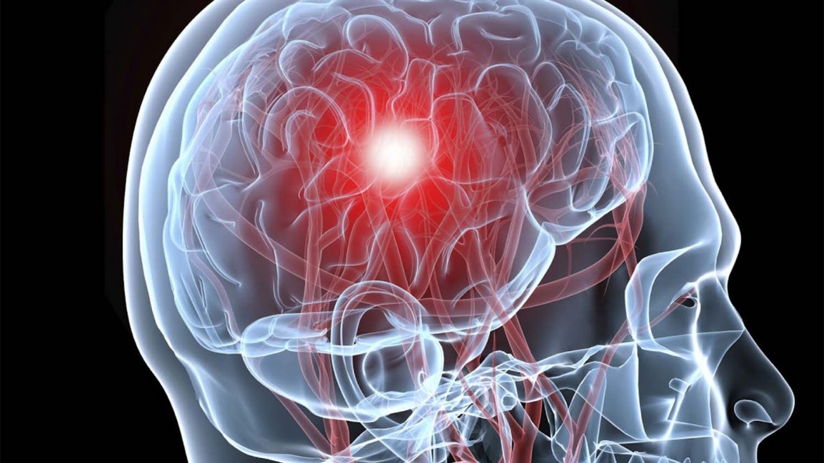 Lesiones cerebrales: ¿cómo tratar una de las principales causas de discapacidad?