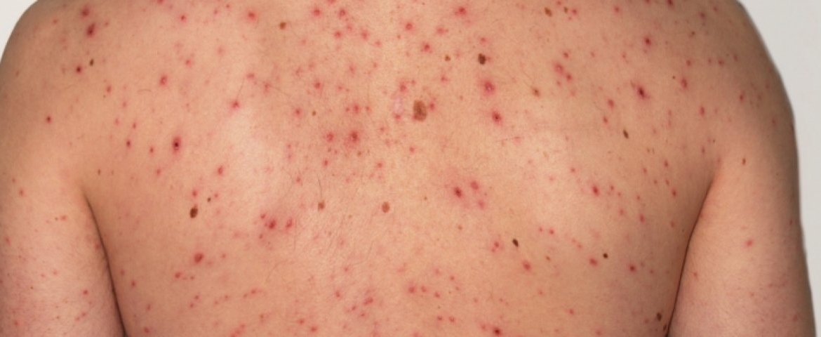 La OMS advirtió que el sarampión tuvo este año un fuerte avance en el mundo