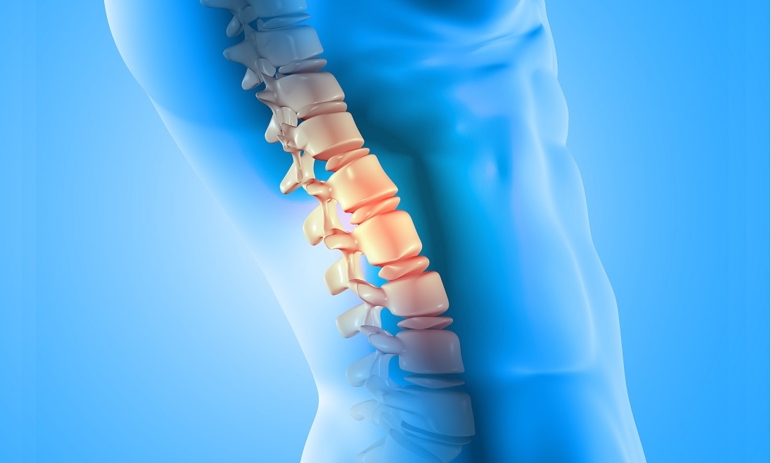 Prevención de fracturas por osteoporosis